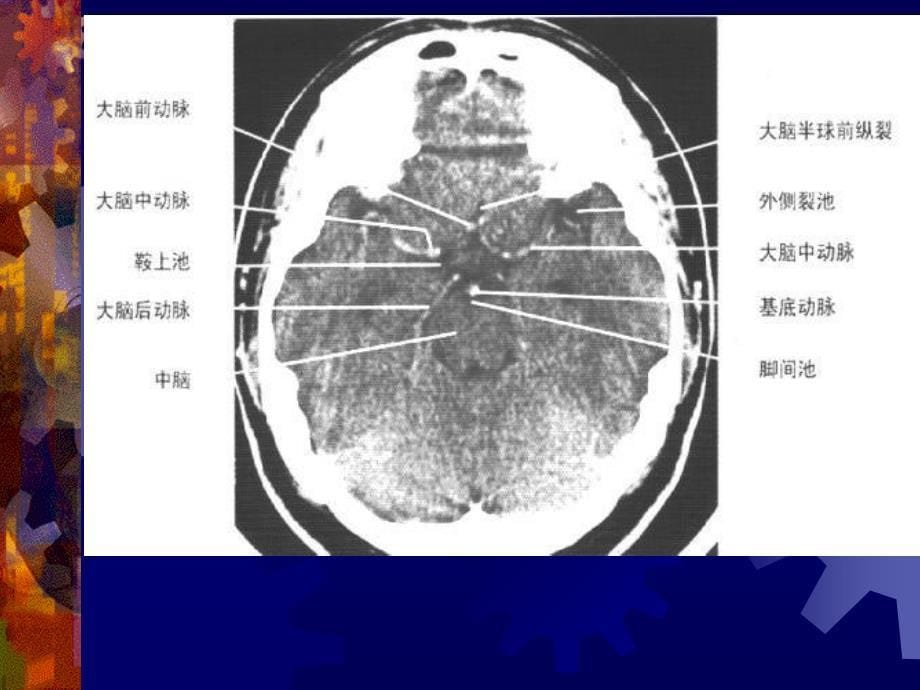 正常头颅 ct 及 mri 解剖_第5页