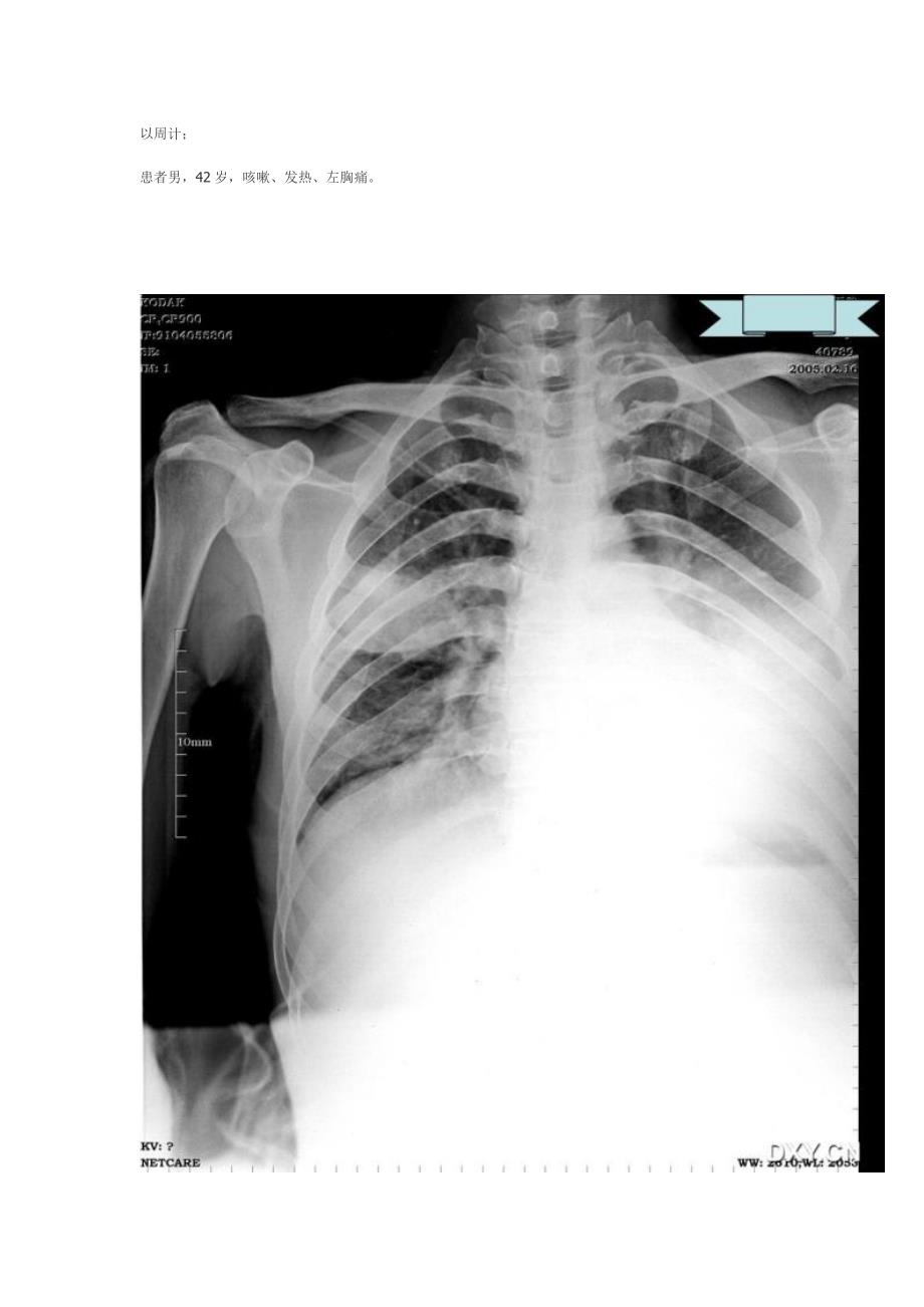 肺炎症、结核、肿瘤在ct与胸片上的区别_第2页