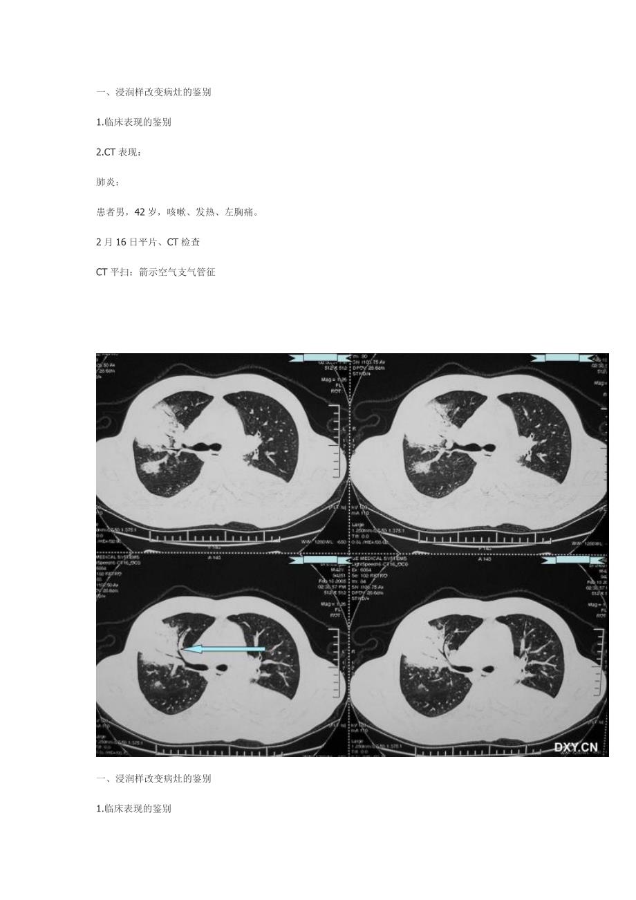 肺炎症、结核、肿瘤在ct与胸片上的区别_第3页