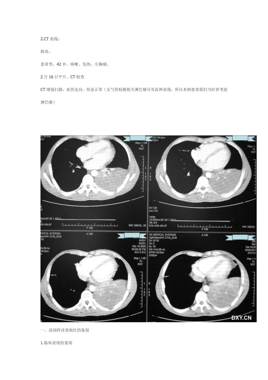 肺炎症、结核、肿瘤在ct与胸片上的区别_第4页