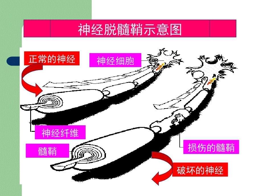 多发性硬化临床诊治-新ppt_第5页