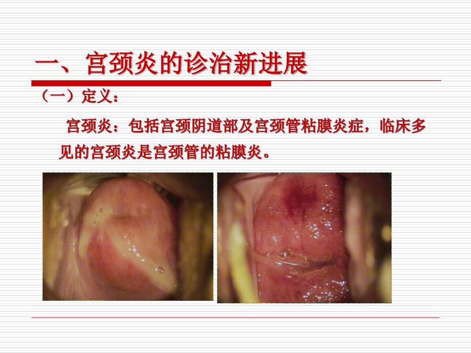 宫颈疾病诊治中值得重视几个问题_第3页