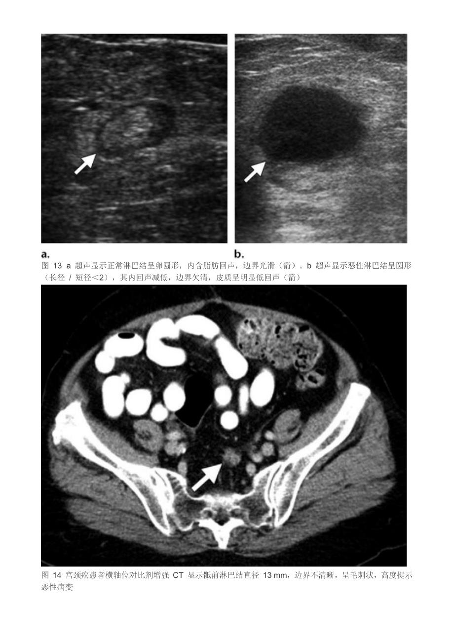 实用教程：妇科恶性肿瘤淋巴结转移的影像评估_第3页