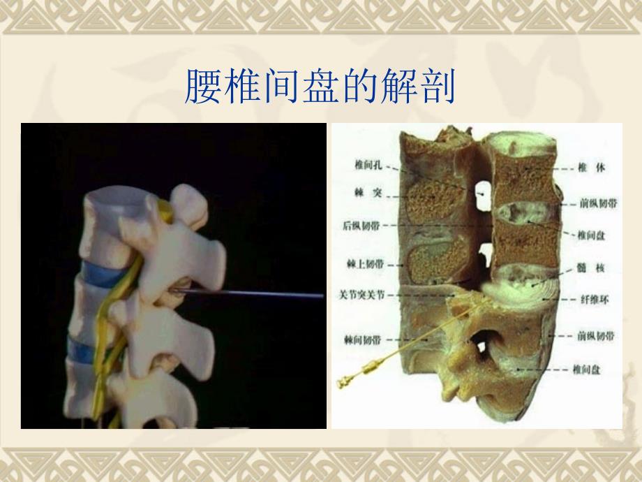 腰椎间盘突出.ppt_第3页