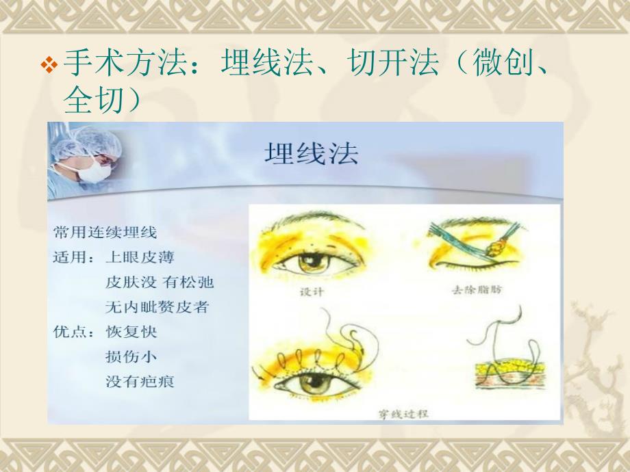 整形美容之眼部整形.ppt_第4页