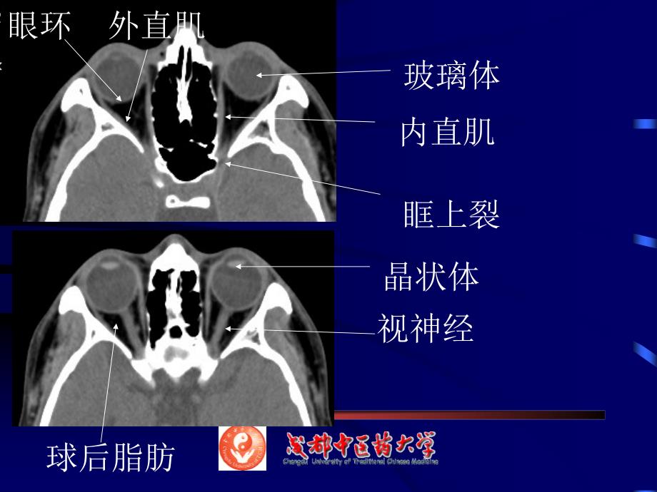 眼耳鼻喉ct解剖_第3页