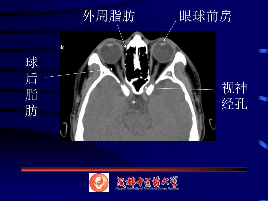 眼耳鼻喉ct解剖_第4页