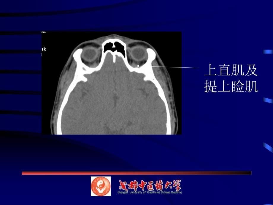 眼耳鼻喉ct解剖_第5页