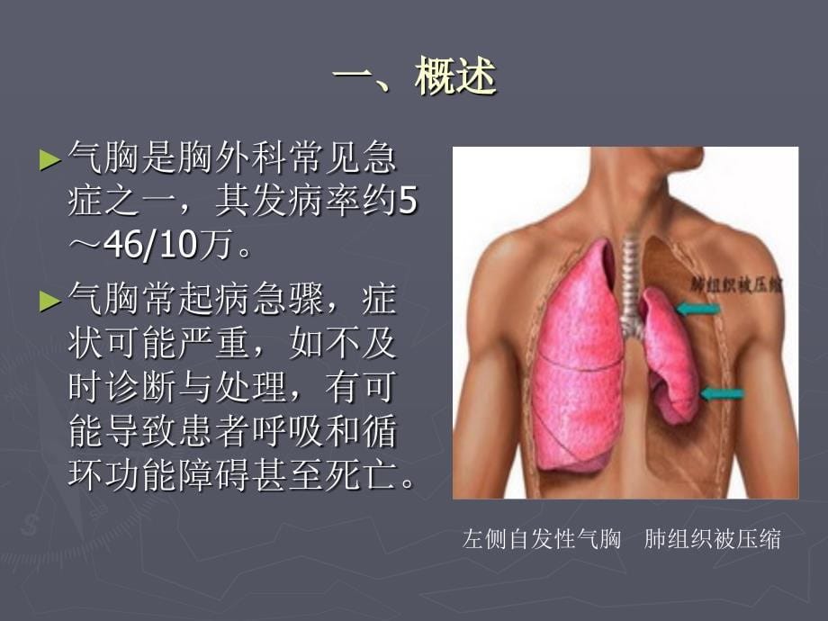 胸外科常见疾病的诊治——一自发性气胸_第5页