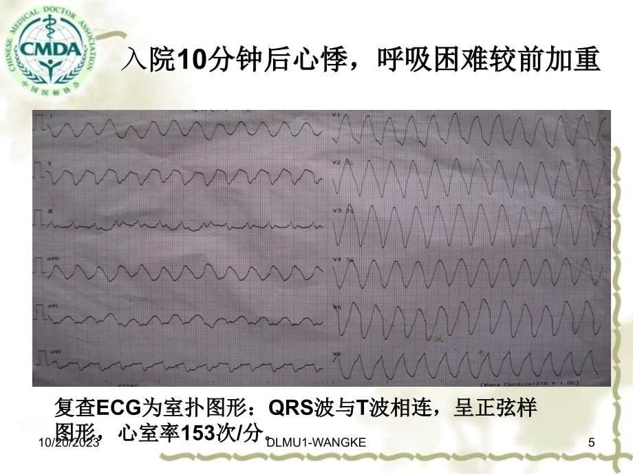 高钾血症所致窦室传导和室扑心电图分析--朱杰大连.ppt_第5页