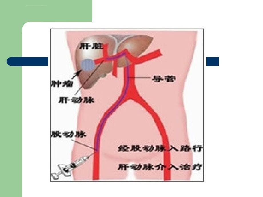 肿瘤介入治疗护理查房.ppt_第5页