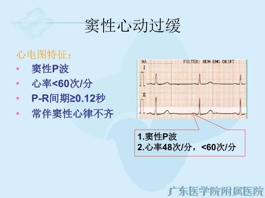 激动起源异常课件(修改版).ppt_第5页