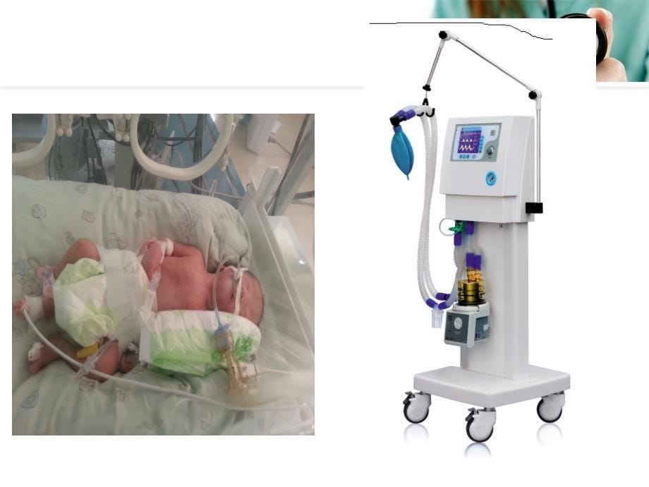 新生儿呼吸机应用及护理对_第5页
