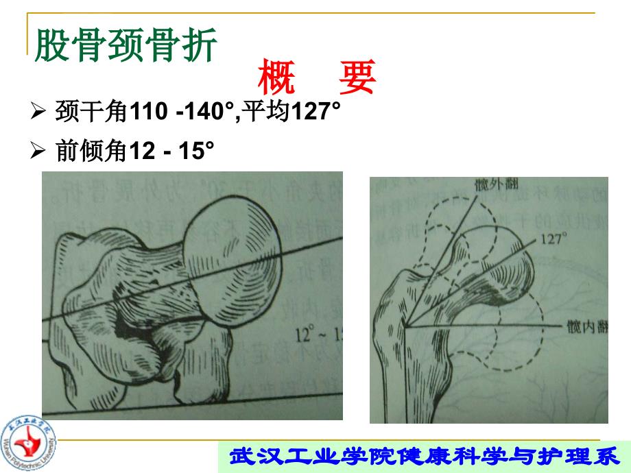 浅谈股骨颈骨折康复.ppt_第2页