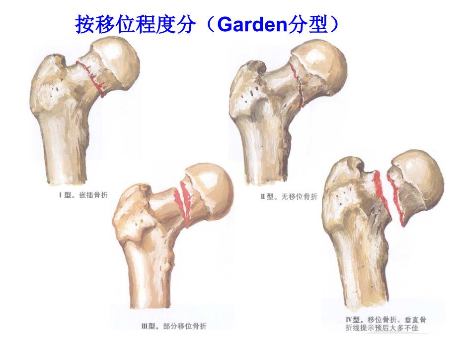 浅谈股骨颈骨折康复.ppt_第4页