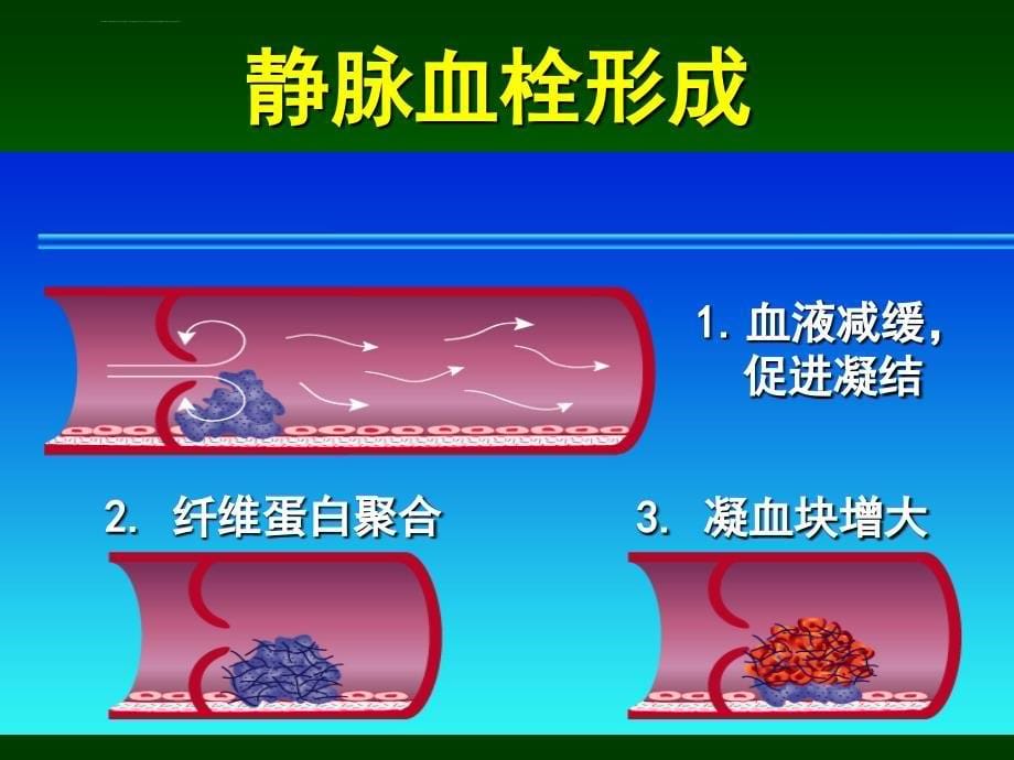 静脉栓塞就在我们身边.ppt_第5页