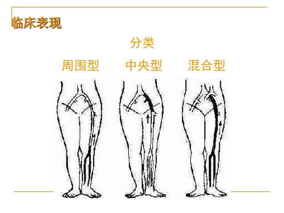 关节置换术后的防栓与治凝.ppt_第5页