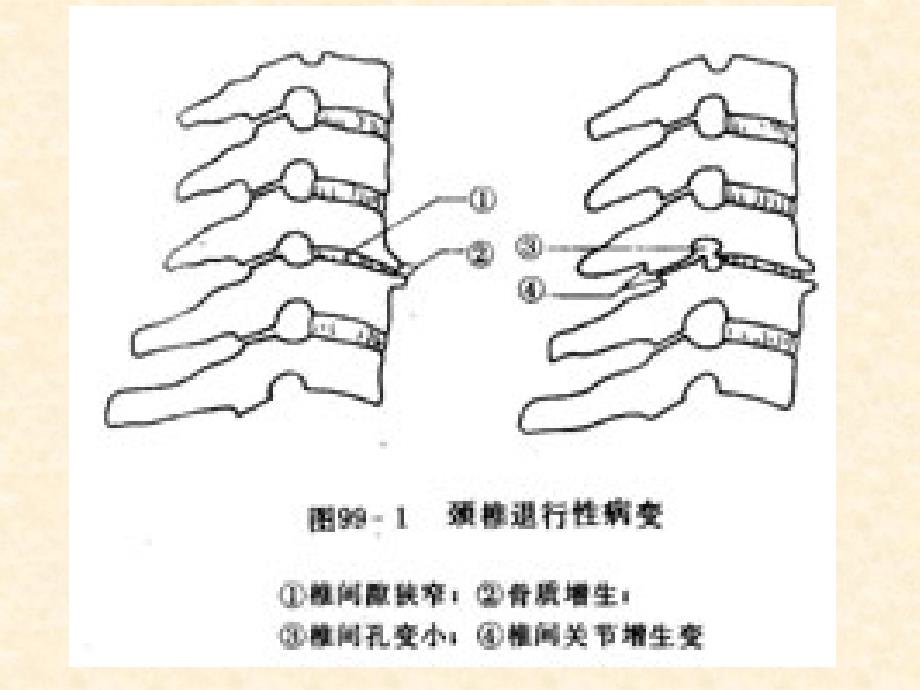 侧屈位椎间孔挤压试验资料_第4页