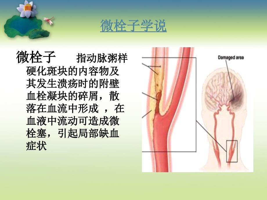 tia短暂性脑出血发作_第4页