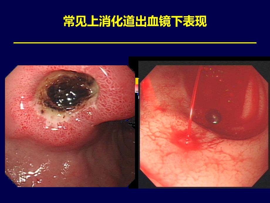 2016急诊急性上消化道出血紧急处理资料_第3页
