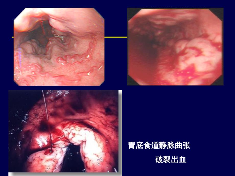 2016急诊急性上消化道出血紧急处理资料_第4页