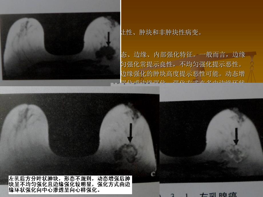 乳腺恶性病变的mri_第4页