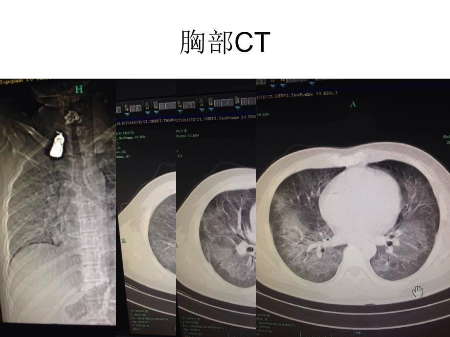 pcp病例分析及详解资料_第5页