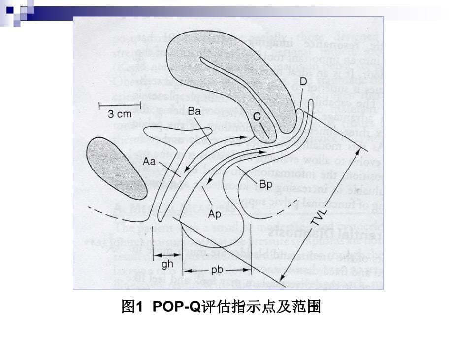 如何应用和评价pop-q评估体系ppt课件_第5页