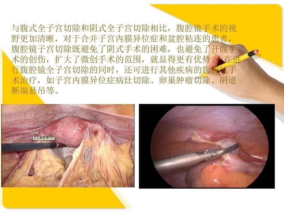 腹腔镜辅助下阴式全子宫切除术手术护理查房资料_第5页