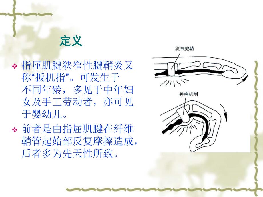 狭窄性腱鞘炎的针刀治疗.ppt_第2页