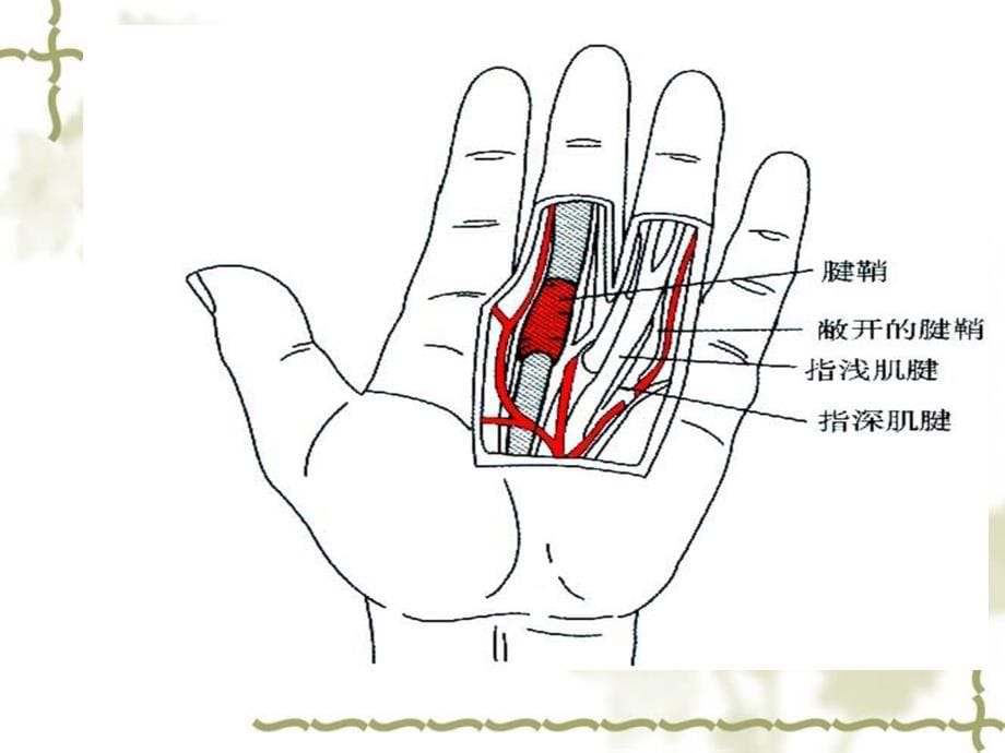 狭窄性腱鞘炎的针刀治疗.ppt_第5页