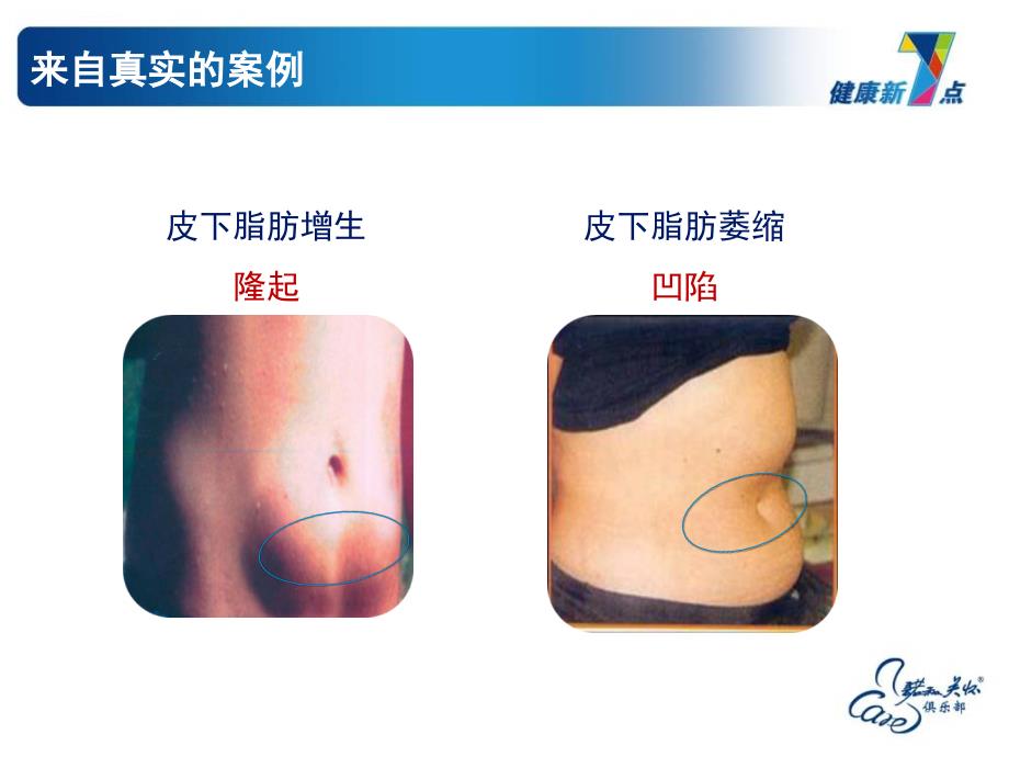 患者教育课件-13篇-注射篇-mde-p-2014-1.ppt_第4页