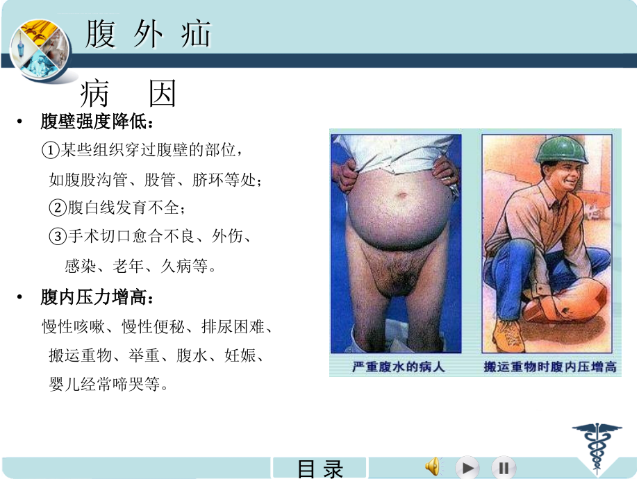 腹外疝（（2011南医）.ppt_第4页