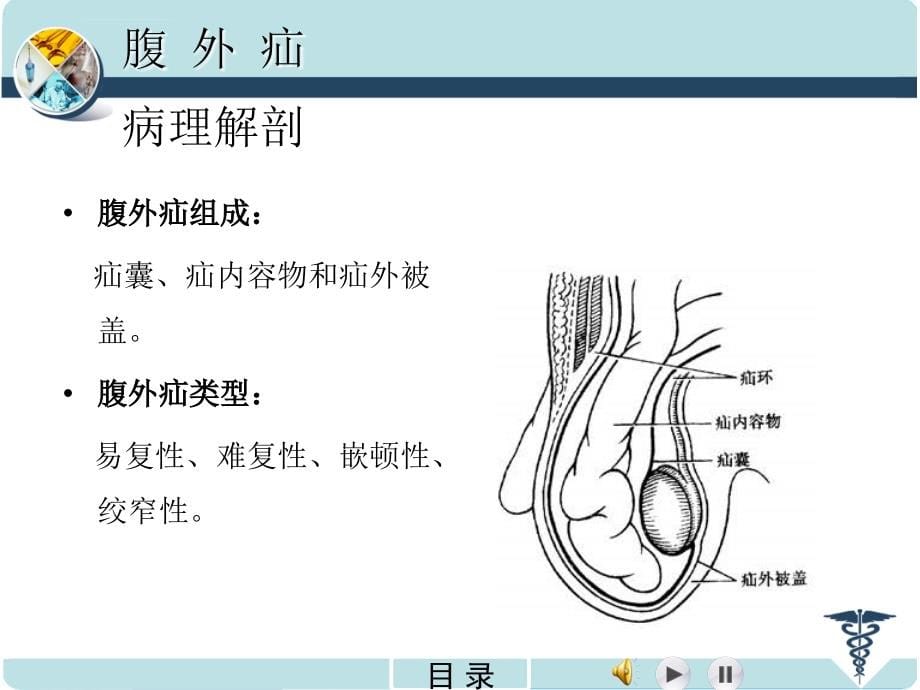 腹外疝（（2011南医）.ppt_第5页