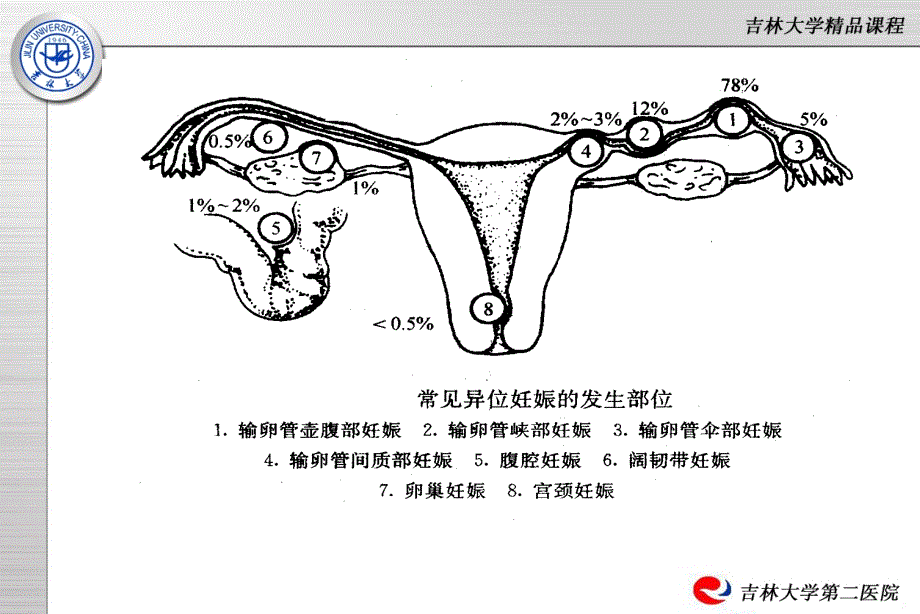 第十一章异位妊娠.ppt_第3页