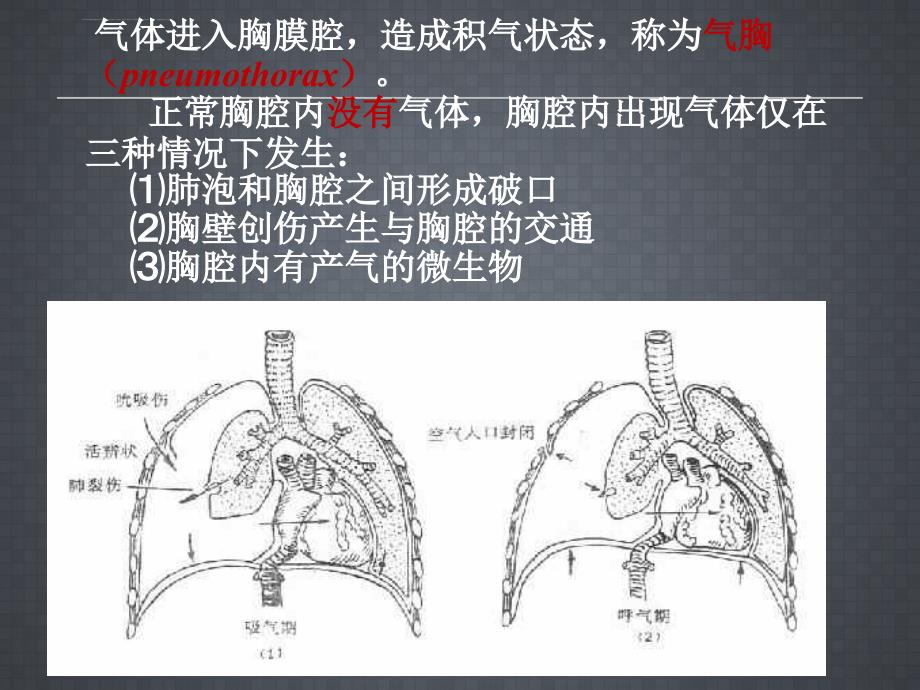 胸腔闭式引流术课件_3.ppt_第3页