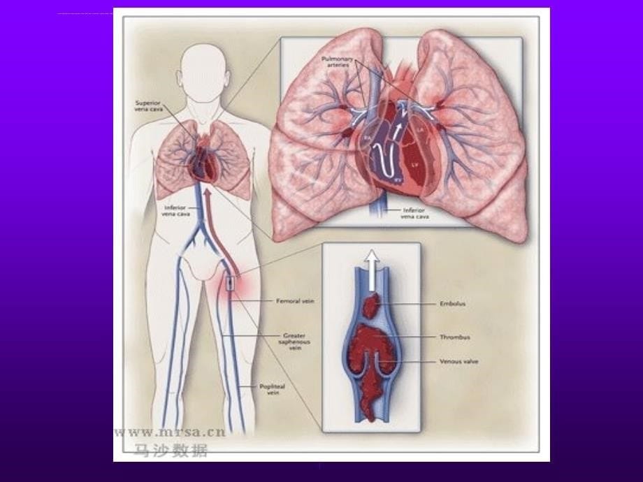 肺栓塞-肺血栓栓塞症--绝好的课件-推荐.ppt_第5页