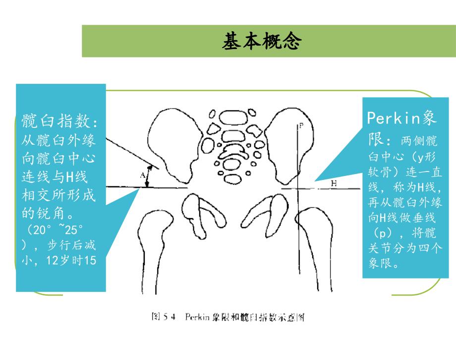 发育性髋关节脱位资料_第4页