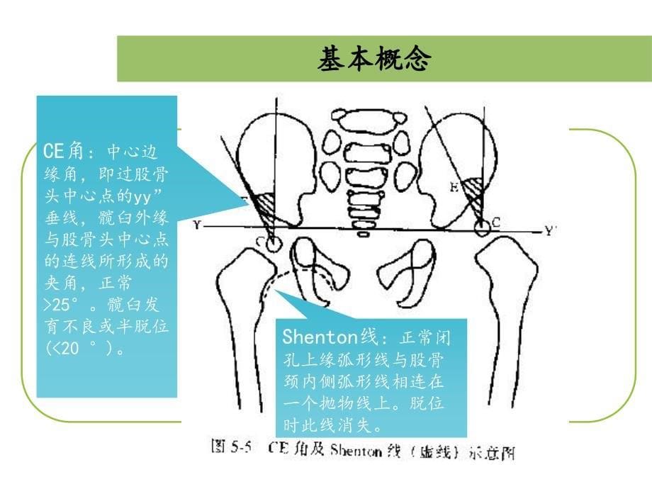 发育性髋关节脱位资料_第5页