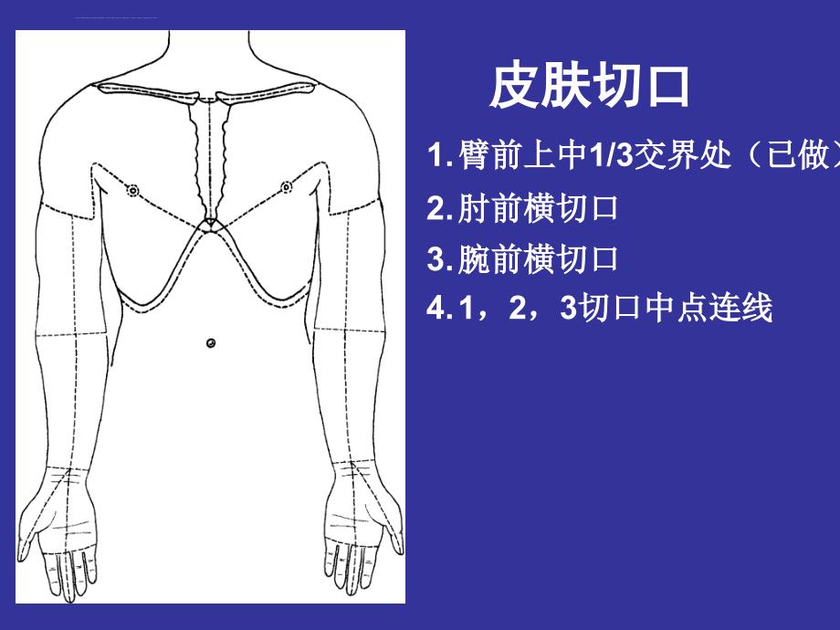 上肢前区颈前区腹前外侧壁局部解剖学.ppt_第4页