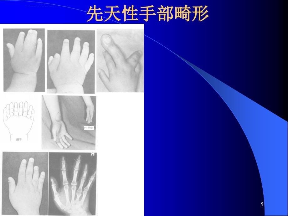 运动系统畸形.ppt_第5页