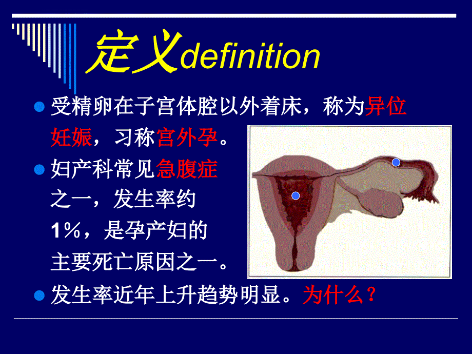 异位妊娠课件段钊.ppt_第3页