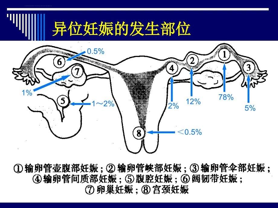 异位妊娠课件段钊.ppt_第5页