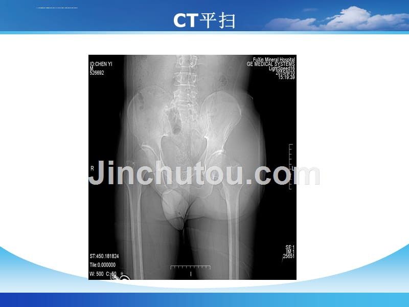 脂肪肉瘤的影像表现.ppt_第3页