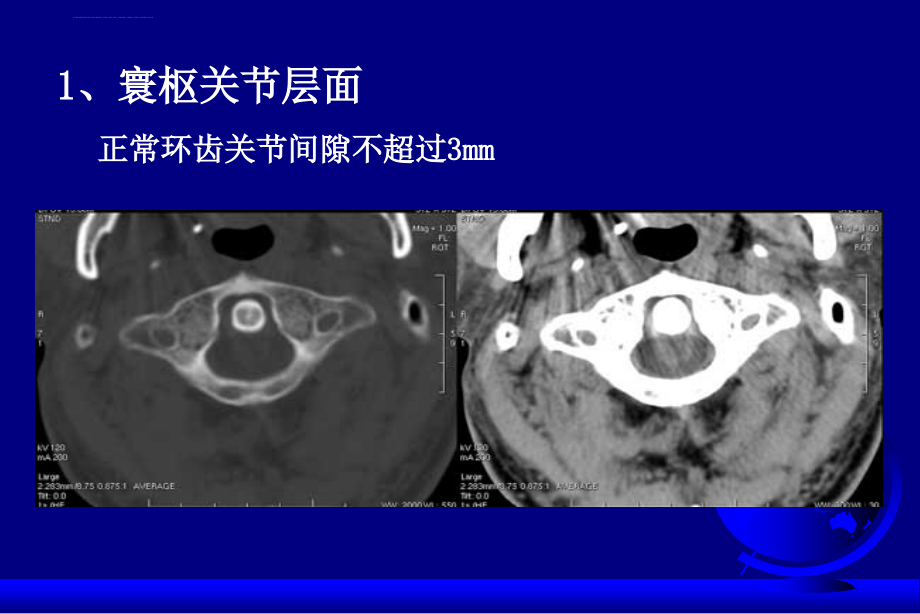 颈椎和颈髓病变影像学诊断-沈建敏.ppt_第3页