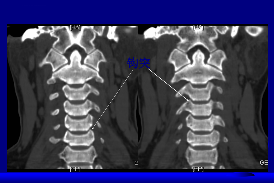 颈椎和颈髓病变影像学诊断-沈建敏.ppt_第4页