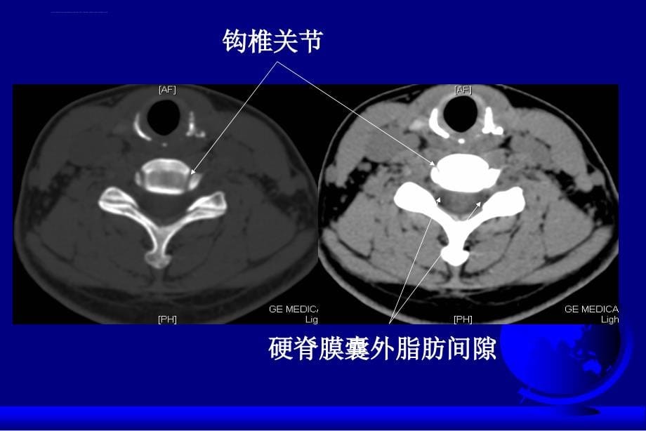 颈椎和颈髓病变影像学诊断-沈建敏.ppt_第5页