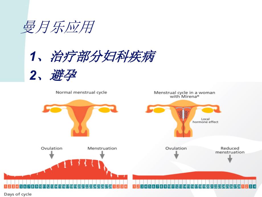 曼月乐临床应用.ppt_第2页