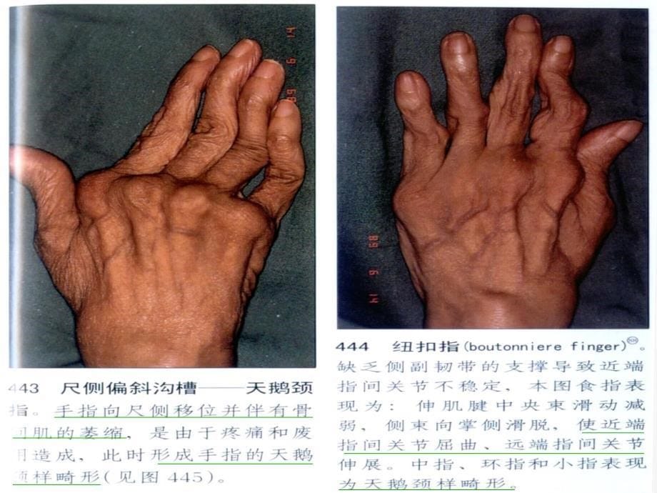 类风湿性关节炎中医治疗方案介绍.ppt_第5页