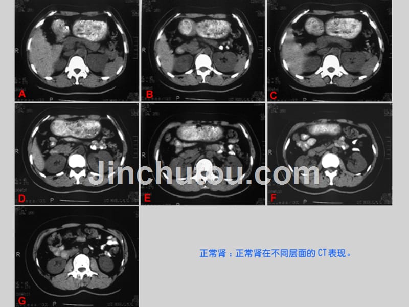 泌尿生殖系统和腹膜后间隙(新疆医科大ct诊断课件-).ppt_第4页